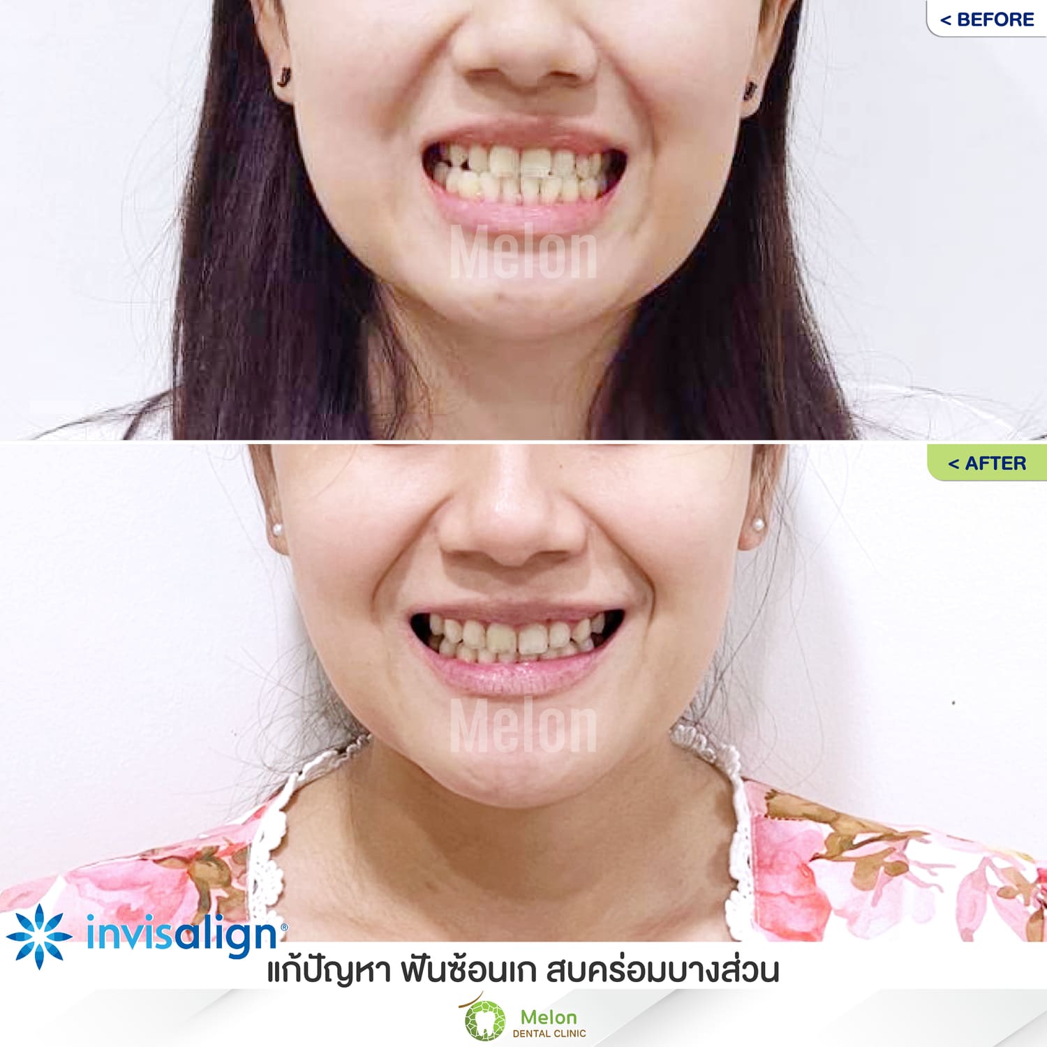 Review-of-clear-braces-2.jpg