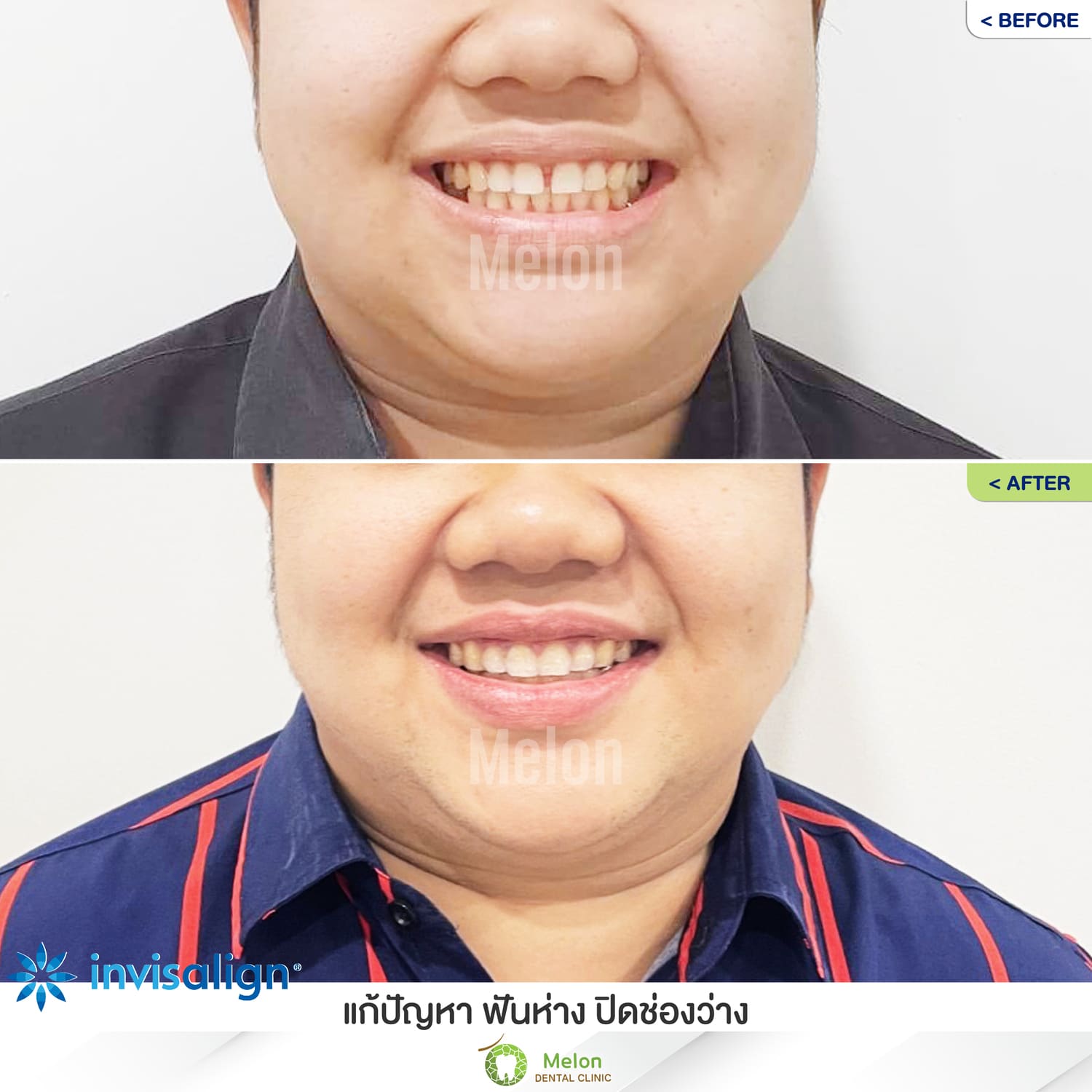 Review-of-clear-braces-5.jpg