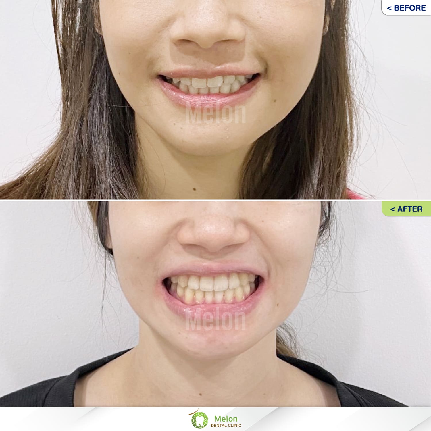 Second-round-of-braces-review-3.jpg