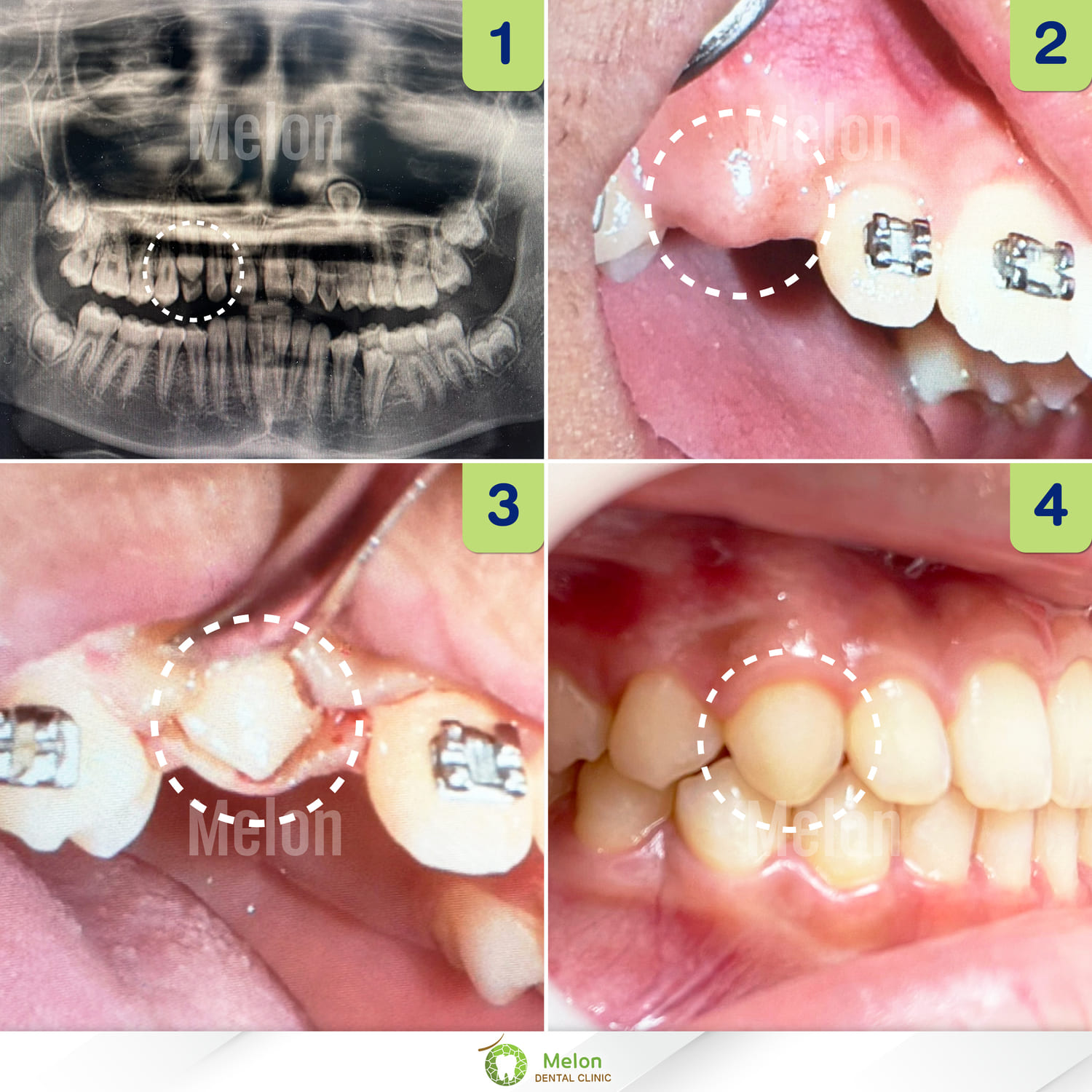 pulling-implanted-teeth-1.jpg