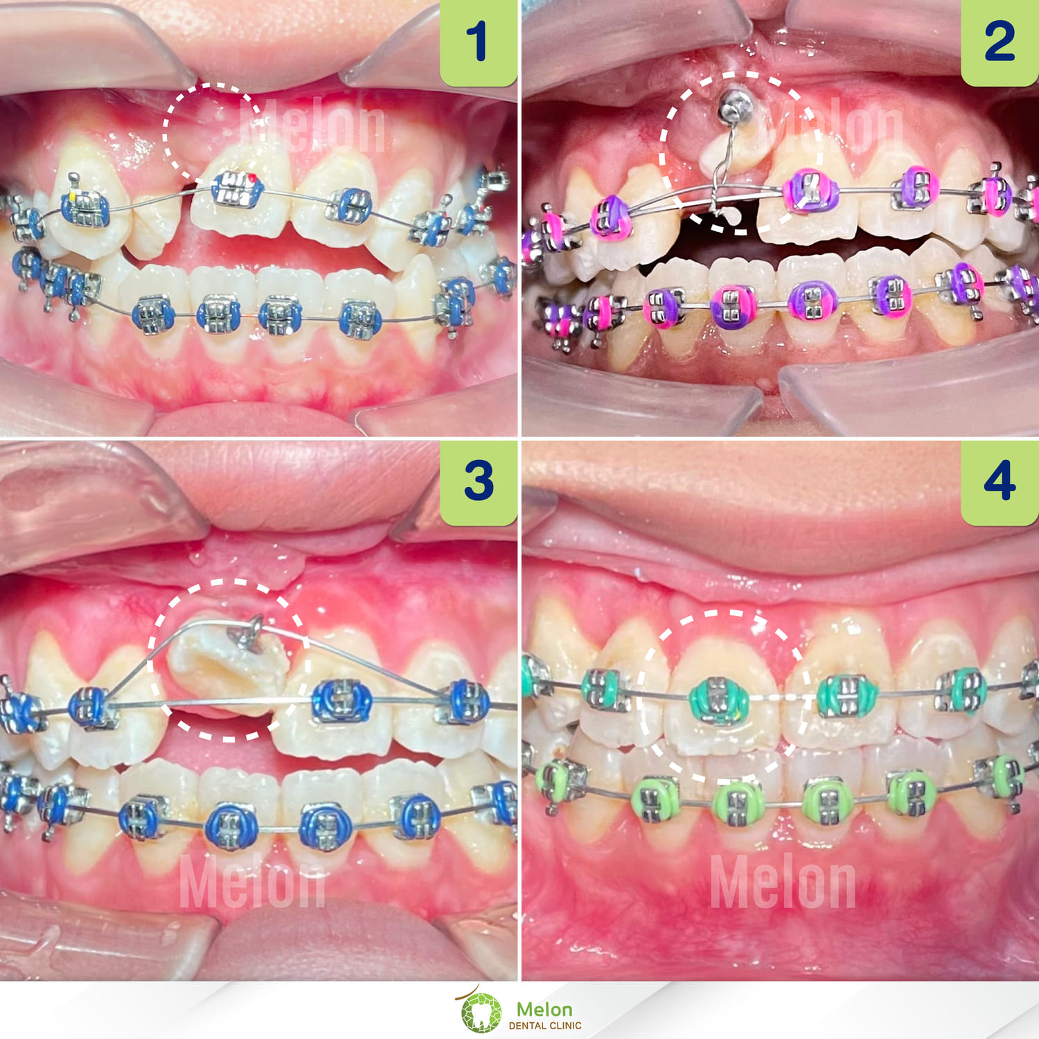 pulling-implanted-teeth-2.jpg