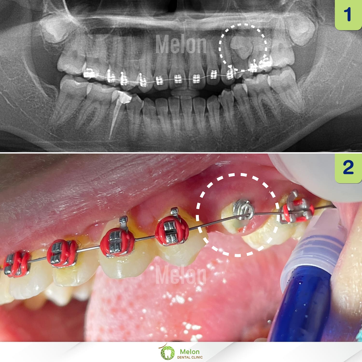 pulling-implanted-teeth-3.jpg