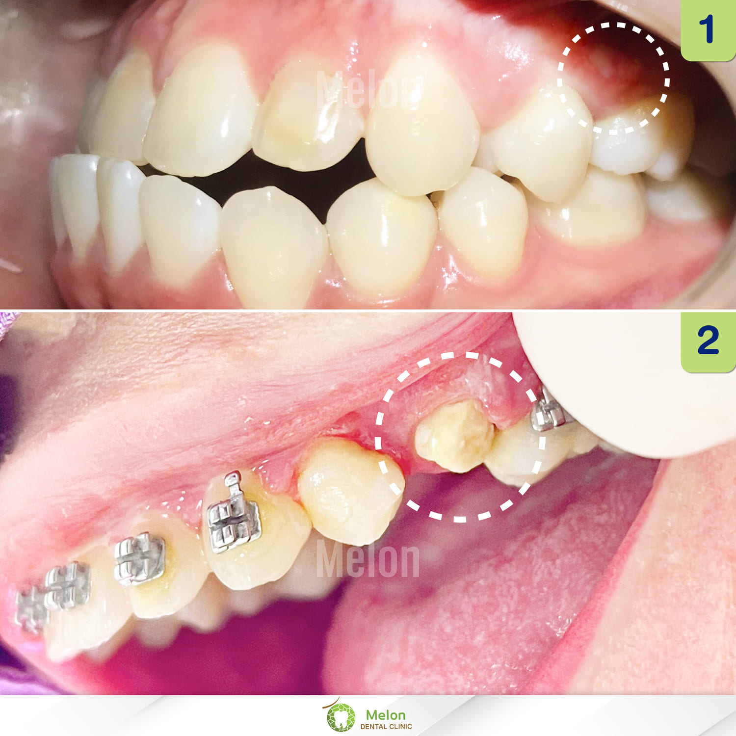 pulling-implanted-teeth-4.jpg